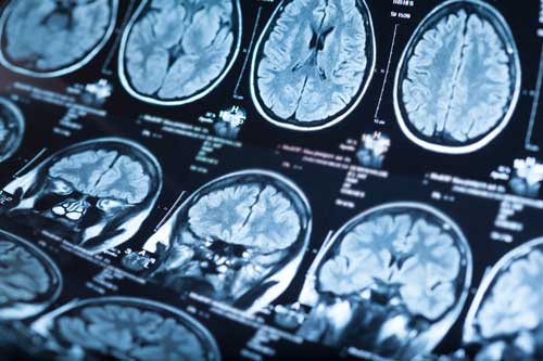 Brain Injury Accident